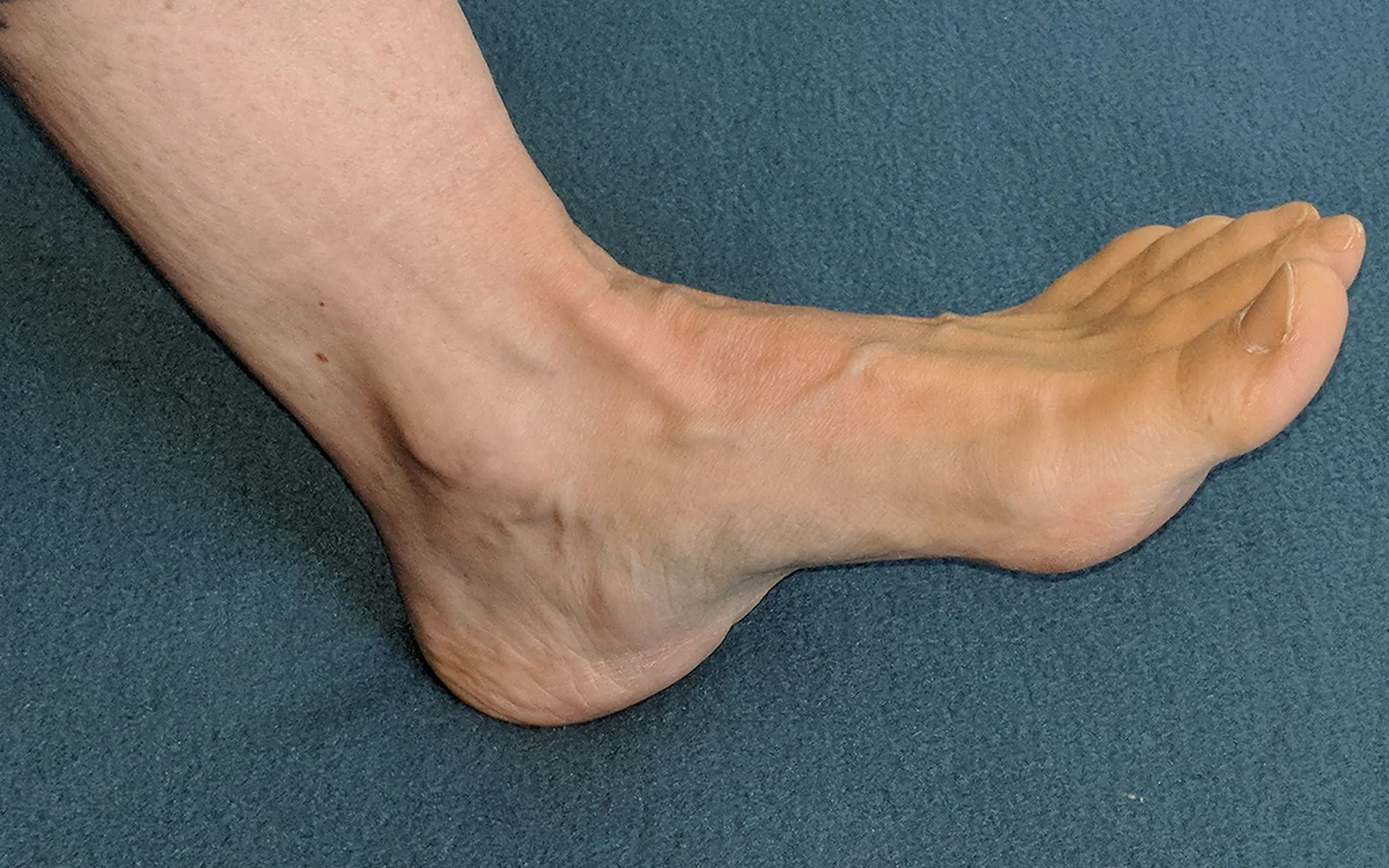 Clinical Relevance of Overpronation Teaser Image