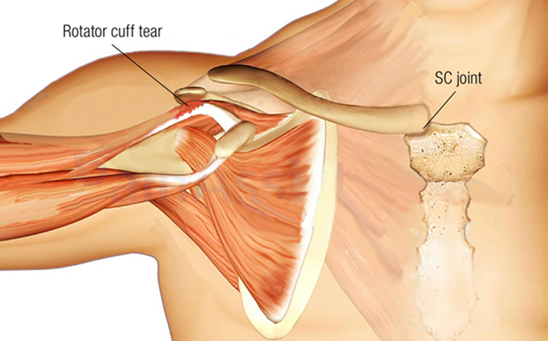 Don't Blame the Rotator Cuff Teaser Image