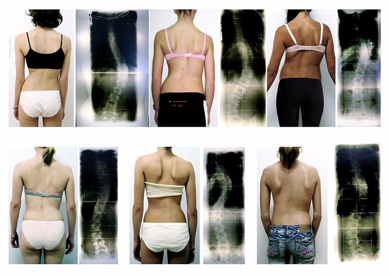 MA20 Scoliosis 3 MA20 Scoliosis 3