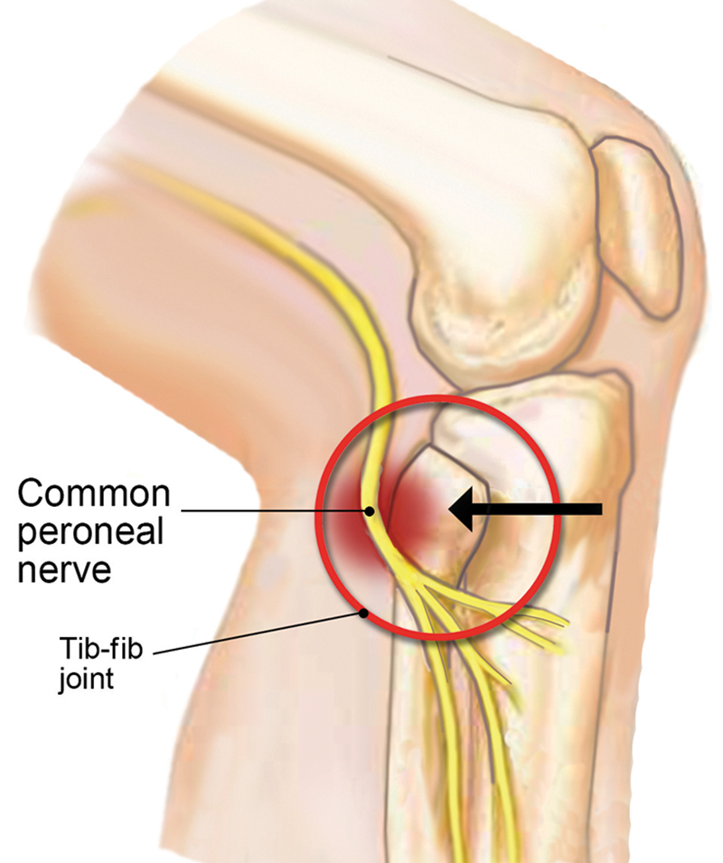 MJ20_Superior TibFib4 MJ20_Superior TibFib4